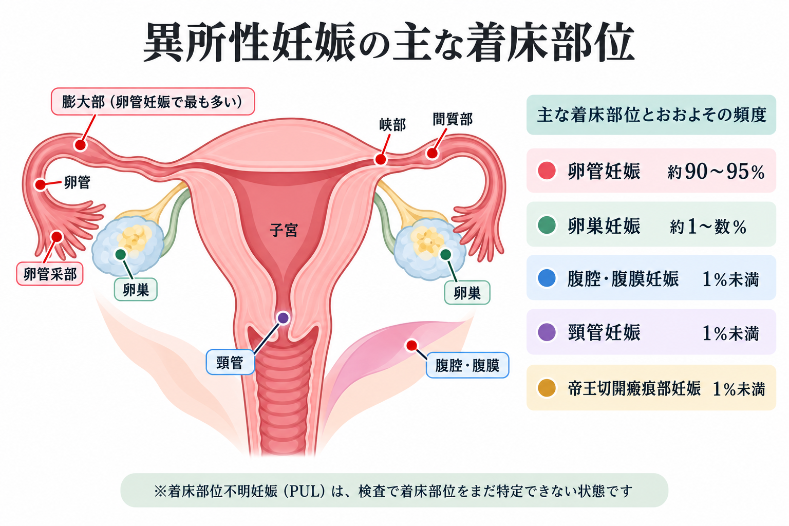 異所性妊娠の主な着床部位