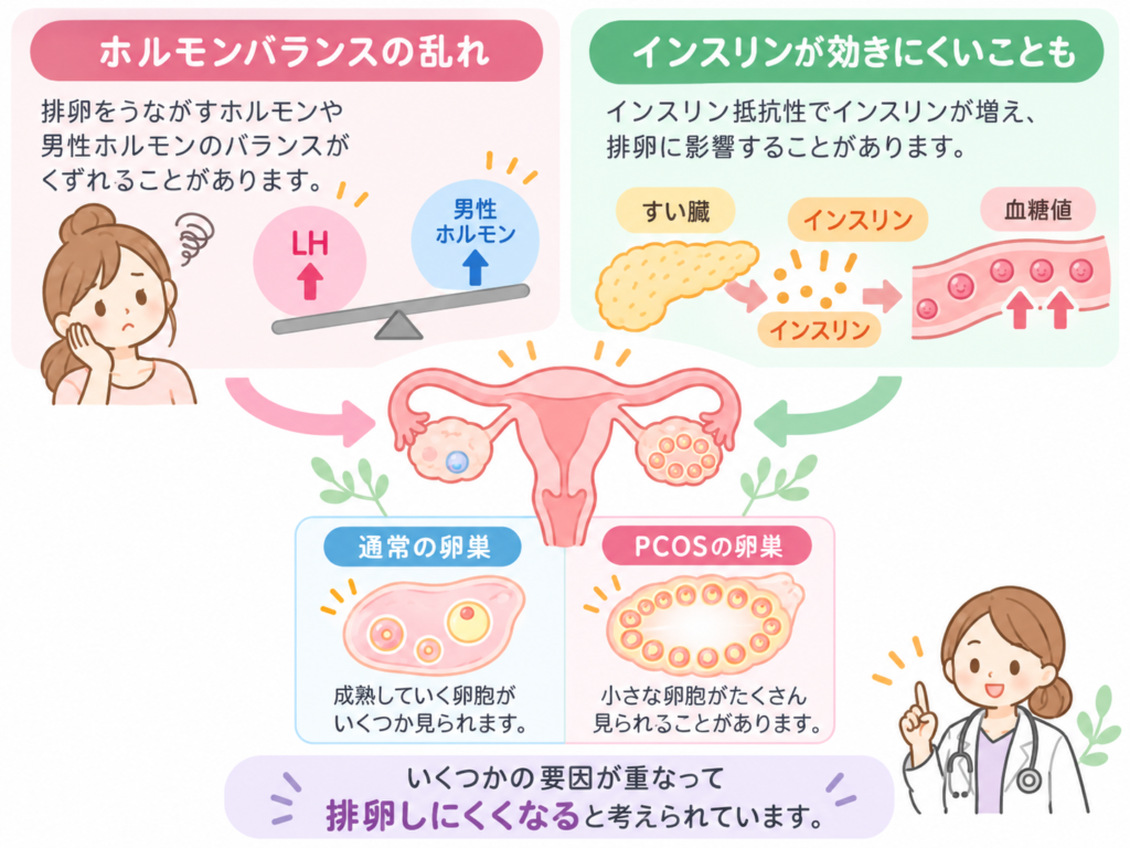PCOSの症状のイラスト
