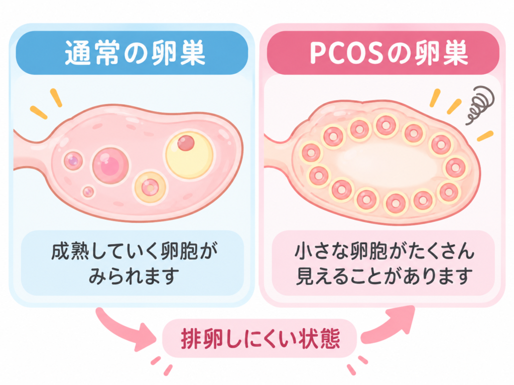 PCOSの原因(ホルモンバランスの乱れ)のイラスト