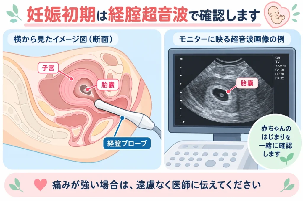 経腟超音波検査のイメージ図